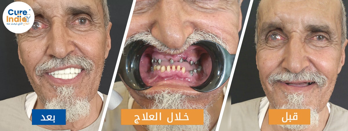 محمد الغامدي - تجربتي مع زراعة الاسنان